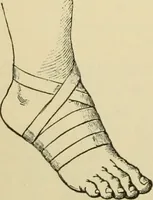 An illustration from Surgical technic; a text-book on operative surgery / by Fr. von Esmarch ... and E. Kowalzig ... translated by Professor Ludwig H. Grau ... and Willam N. Sullivan ... edited by Nicholas Senn ... With fourteen hundred and ninety-seven illustrations and fifteen colored plates. (1901)