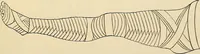 An illustration from Surgical technic; a text-book on operative surgery / by Fr. von Esmarch ... and E. Kowalzig ... translated by Professor Ludwig H. Grau ... and Willam N. Sullivan ... edited by Nicholas Senn ... With fourteen hundred and ninety-seven illustrations and fifteen colored plates. (1901)