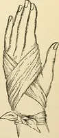 An illustration from Surgical technic; a text-book on operative surgery / by Fr. von Esmarch ... and E. Kowalzig ... translated by Professor Ludwig H. Grau ... and Willam N. Sullivan ... edited by Nicholas Senn ... With fourteen hundred and ninety-seven illustrations and fifteen colored plates. (1901)