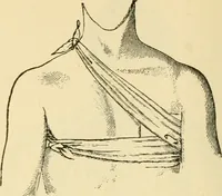 An illustration from Surgical technic; a text-book on operative surgery / by Fr. von Esmarch ... and E. Kowalzig ... translated by Professor Ludwig H. Grau ... and Willam N. Sullivan ... edited by Nicholas Senn ... With fourteen hundred and ninety-seven illustrations and fifteen colored plates. (1901)