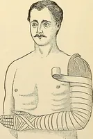An illustration from Surgical technic; a text-book on operative surgery / by Fr. von Esmarch ... and E. Kowalzig ... translated by Professor Ludwig H. Grau ... and Willam N. Sullivan ... edited by Nicholas Senn ... With fourteen hundred and ninety-seven illustrations and fifteen colored plates. (1901)
