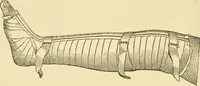 An illustration from Surgical technic; a text-book on operative surgery / by Fr. von Esmarch ... and E. Kowalzig ... translated by Professor Ludwig H. Grau ... and Willam N. Sullivan ... edited by Nicholas Senn ... With fourteen hundred and ninety-seven illustrations and fifteen colored plates. (1901)