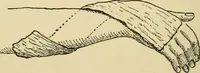 An illustration from Surgical technic; a text-book on operative surgery / by Fr. von Esmarch ... and E. Kowalzig ... translated by Professor Ludwig H. Grau ... and Willam N. Sullivan ... edited by Nicholas Senn ... With fourteen hundred and ninety-seven illustrations and fifteen colored plates. (1901)