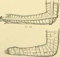 An illustration from Surgical technic; a text-book on operative surgery / by Fr. von Esmarch ... and E. Kowalzig ... translated by Professor Ludwig H. Grau ... and Willam N. Sullivan ... edited by Nicholas Senn ... With fourteen hundred and ninety-seven illustrations and fifteen colored plates. (1901)