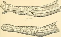 An illustration from Surgical technic; a text-book on operative surgery / by Fr. von Esmarch ... and E. Kowalzig ... translated by Professor Ludwig H. Grau ... and Willam N. Sullivan ... edited by Nicholas Senn ... With fourteen hundred and ninety-seven illustrations and fifteen colored plates. (1901)