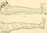 An illustration from Surgical technic; a text-book on operative surgery / by Fr. von Esmarch ... and E. Kowalzig ... translated by Professor Ludwig H. Grau ... and Willam N. Sullivan ... edited by Nicholas Senn ... With fourteen hundred and ninety-seven illustrations and fifteen colored plates. (1901)