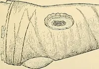 An illustration from Surgical technic; a text-book on operative surgery / by Fr. von Esmarch ... and E. Kowalzig ... translated by Professor Ludwig H. Grau ... and Willam N. Sullivan ... edited by Nicholas Senn ... With fourteen hundred and ninety-seven illustrations and fifteen colored plates. (1901)