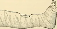 An illustration from Surgical technic; a text-book on operative surgery / by Fr. von Esmarch ... and E. Kowalzig ... translated by Professor Ludwig H. Grau ... and Willam N. Sullivan ... edited by Nicholas Senn ... With fourteen hundred and ninety-seven illustrations and fifteen colored plates. (1901)