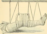 An illustration from Surgical technic; a text-book on operative surgery / by Fr. von Esmarch ... and E. Kowalzig ... translated by Professor Ludwig H. Grau ... and Willam N. Sullivan ... edited by Nicholas Senn ... With fourteen hundred and ninety-seven illustrations and fifteen colored plates. (1901)