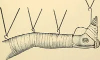 An illustration from Surgical technic; a text-book on operative surgery / by Fr. von Esmarch ... and E. Kowalzig ... translated by Professor Ludwig H. Grau ... and Willam N. Sullivan ... edited by Nicholas Senn ... With fourteen hundred and ninety-seven illustrations and fifteen colored plates. (1901)