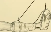 An illustration from Surgical technic; a text-book on operative surgery / by Fr. von Esmarch ... and E. Kowalzig ... translated by Professor Ludwig H. Grau ... and Willam N. Sullivan ... edited by Nicholas Senn ... With fourteen hundred and ninety-seven illustrations and fifteen colored plates. (1901)