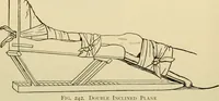 An illustration from Surgical technic; a text-book on operative surgery / by Fr. von Esmarch ... and E. Kowalzig ... translated by Professor Ludwig H. Grau ... and Willam N. Sullivan ... edited by Nicholas Senn ... With fourteen hundred and ninety-seven illustrations and fifteen colored plates. (1901)