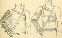 An illustration from Surgical technic; a text-book on operative surgery / by Fr. von Esmarch ... and E. Kowalzig ... translated by Professor Ludwig H. Grau ... and Willam N. Sullivan ... edited by Nicholas Senn ... With fourteen hundred and ninety-seven illustrations and fifteen colored plates. (1901)
