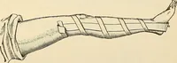 An illustration from Surgical technic; a text-book on operative surgery / by Fr. von Esmarch ... and E. Kowalzig ... translated by Professor Ludwig H. Grau ... and Willam N. Sullivan ... edited by Nicholas Senn ... With fourteen hundred and ninety-seven illustrations and fifteen colored plates. (1901)