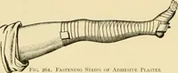 An illustration from Surgical technic; a text-book on operative surgery / by Fr. von Esmarch ... and E. Kowalzig ... translated by Professor Ludwig H. Grau ... and Willam N. Sullivan ... edited by Nicholas Senn ... With fourteen hundred and ninety-seven illustrations and fifteen colored plates. (1901)