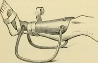 An illustration from Surgical technic; a text-book on operative surgery / by Fr. von Esmarch ... and E. Kowalzig ... translated by Professor Ludwig H. Grau ... and Willam N. Sullivan ... edited by Nicholas Senn ... With fourteen hundred and ninety-seven illustrations and fifteen colored plates. (1901)