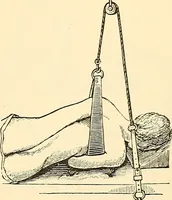 An illustration from Surgical technic; a text-book on operative surgery / by Fr. von Esmarch ... and E. Kowalzig ... translated by Professor Ludwig H. Grau ... and Willam N. Sullivan ... edited by Nicholas Senn ... With fourteen hundred and ninety-seven illustrations and fifteen colored plates. (1901)