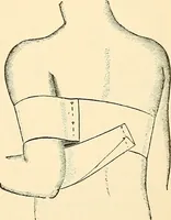 An illustration from Surgical technic; a text-book on operative surgery / by Fr. von Esmarch ... and E. Kowalzig ... translated by Professor Ludwig H. Grau ... and Willam N. Sullivan ... edited by Nicholas Senn ... With fourteen hundred and ninety-seven illustrations and fifteen colored plates. (1901)