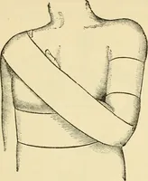An illustration from Surgical technic; a text-book on operative surgery / by Fr. von Esmarch ... and E. Kowalzig ... translated by Professor Ludwig H. Grau ... and Willam N. Sullivan ... edited by Nicholas Senn ... With fourteen hundred and ninety-seven illustrations and fifteen colored plates. (1901)