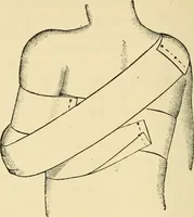 An illustration from Surgical technic; a text-book on operative surgery / by Fr. von Esmarch ... and E. Kowalzig ... translated by Professor Ludwig H. Grau ... and Willam N. Sullivan ... edited by Nicholas Senn ... With fourteen hundred and ninety-seven illustrations and fifteen colored plates. (1901)