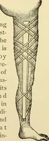 An illustration from Surgical technic; a text-book on operative surgery / by Fr. von Esmarch ... and E. Kowalzig ... translated by Professor Ludwig H. Grau ... and Willam N. Sullivan ... edited by Nicholas Senn ... With fourteen hundred and ninety-seven illustrations and fifteen colored plates. (1901)