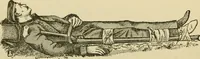 An illustration from Surgical technic; a text-book on operative surgery / by Fr. von Esmarch ... and E. Kowalzig ... translated by Professor Ludwig H. Grau ... and Willam N. Sullivan ... edited by Nicholas Senn ... With fourteen hundred and ninety-seven illustrations and fifteen colored plates. (1901)