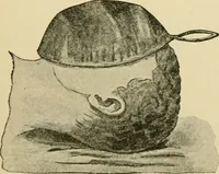An illustration from Surgical technic; a text-book on operative surgery / by Fr. von Esmarch ... and E. Kowalzig ... translated by Professor Ludwig H. Grau ... and Willam N. Sullivan ... edited by Nicholas Senn ... With fourteen hundred and ninety-seven illustrations and fifteen colored plates. (1901)