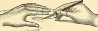 An illustration from Surgical technic; a text-book on operative surgery / by Fr. von Esmarch ... and E. Kowalzig ... translated by Professor Ludwig H. Grau ... and Willam N. Sullivan ... edited by Nicholas Senn ... With fourteen hundred and ninety-seven illustrations and fifteen colored plates. (1901)