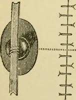 An illustration from Surgical technic; a text-book on operative surgery / by Fr. von Esmarch ... and E. Kowalzig ... translated by Professor Ludwig H. Grau ... and Willam N. Sullivan ... edited by Nicholas Senn ... With fourteen hundred and ninety-seven illustrations and fifteen colored plates. (1901)