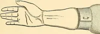 An illustration from Surgical technic; a text-book on operative surgery / by Fr. von Esmarch ... and E. Kowalzig ... translated by Professor Ludwig H. Grau ... and Willam N. Sullivan ... edited by Nicholas Senn ... With fourteen hundred and ninety-seven illustrations and fifteen colored plates. (1901)
