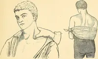 An illustration from Surgical technic; a text-book on operative surgery / by Fr. von Esmarch ... and E. Kowalzig ... translated by Professor Ludwig H. Grau ... and Willam N. Sullivan ... edited by Nicholas Senn ... With fourteen hundred and ninety-seven illustrations and fifteen colored plates. (1901)