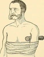 An illustration from Surgical technic; a text-book on operative surgery / by Fr. von Esmarch ... and E. Kowalzig ... translated by Professor Ludwig H. Grau ... and Willam N. Sullivan ... edited by Nicholas Senn ... With fourteen hundred and ninety-seven illustrations and fifteen colored plates. (1901)