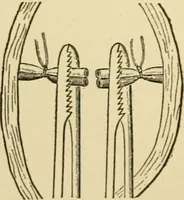 An illustration from Surgical technic; a text-book on operative surgery / by Fr. von Esmarch ... and E. Kowalzig ... translated by Professor Ludwig H. Grau ... and Willam N. Sullivan ... edited by Nicholas Senn ... With fourteen hundred and ninety-seven illustrations and fifteen colored plates. (1901)