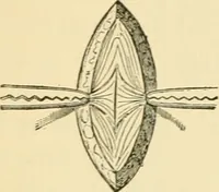 An illustration from Surgical technic; a text-book on operative surgery / by Fr. von Esmarch ... and E. Kowalzig ... translated by Professor Ludwig H. Grau ... and Willam N. Sullivan ... edited by Nicholas Senn ... With fourteen hundred and ninety-seven illustrations and fifteen colored plates. (1901)
