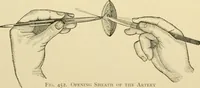 An illustration from Surgical technic; a text-book on operative surgery / by Fr. von Esmarch ... and E. Kowalzig ... translated by Professor Ludwig H. Grau ... and Willam N. Sullivan ... edited by Nicholas Senn ... With fourteen hundred and ninety-seven illustrations and fifteen colored plates. (1901)