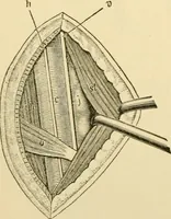 An illustration from Surgical technic; a text-book on operative surgery / by Fr. von Esmarch ... and E. Kowalzig ... translated by Professor Ludwig H. Grau ... and Willam N. Sullivan ... edited by Nicholas Senn ... With fourteen hundred and ninety-seven illustrations and fifteen colored plates. (1901)