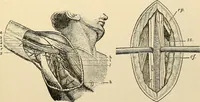 An illustration from Surgical technic; a text-book on operative surgery / by Fr. von Esmarch ... and E. Kowalzig ... translated by Professor Ludwig H. Grau ... and Willam N. Sullivan ... edited by Nicholas Senn ... With fourteen hundred and ninety-seven illustrations and fifteen colored plates. (1901)