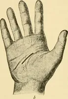 An illustration from Surgical technic; a text-book on operative surgery / by Fr. von Esmarch ... and E. Kowalzig ... translated by Professor Ludwig H. Grau ... and Willam N. Sullivan ... edited by Nicholas Senn ... With fourteen hundred and ninety-seven illustrations and fifteen colored plates. (1901)