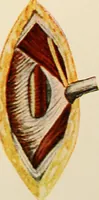 An illustration from Surgical technic; a text-book on operative surgery / by Fr. von Esmarch ... and E. Kowalzig ... translated by Professor Ludwig H. Grau ... and Willam N. Sullivan ... edited by Nicholas Senn ... With fourteen hundred and ninety-seven illustrations and fifteen colored plates. (1901)