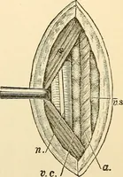 An illustration from Surgical technic; a text-book on operative surgery / by Fr. von Esmarch ... and E. Kowalzig ... translated by Professor Ludwig H. Grau ... and Willam N. Sullivan ... edited by Nicholas Senn ... With fourteen hundred and ninety-seven illustrations and fifteen colored plates. (1901)