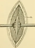 An illustration from Surgical technic; a text-book on operative surgery / by Fr. von Esmarch ... and E. Kowalzig ... translated by Professor Ludwig H. Grau ... and Willam N. Sullivan ... edited by Nicholas Senn ... With fourteen hundred and ninety-seven illustrations and fifteen colored plates. (1901)