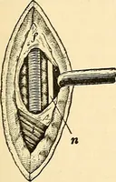 An illustration from Surgical technic; a text-book on operative surgery / by Fr. von Esmarch ... and E. Kowalzig ... translated by Professor Ludwig H. Grau ... and Willam N. Sullivan ... edited by Nicholas Senn ... With fourteen hundred and ninety-seven illustrations and fifteen colored plates. (1901)