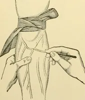 An illustration from Surgical technic; a text-book on operative surgery / by Fr. von Esmarch ... and E. Kowalzig ... translated by Professor Ludwig H. Grau ... and Willam N. Sullivan ... edited by Nicholas Senn ... With fourteen hundred and ninety-seven illustrations and fifteen colored plates. (1901)