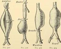 An illustration from Surgical technic; a text-book on operative surgery / by Fr. von Esmarch ... and E. Kowalzig ... translated by Professor Ludwig H. Grau ... and Willam N. Sullivan ... edited by Nicholas Senn ... With fourteen hundred and ninety-seven illustrations and fifteen colored plates. (1901)