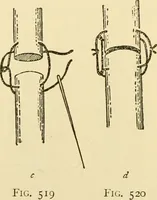 An illustration from Surgical technic; a text-book on operative surgery / by Fr. von Esmarch ... and E. Kowalzig ... translated by Professor Ludwig H. Grau ... and Willam N. Sullivan ... edited by Nicholas Senn ... With fourteen hundred and ninety-seven illustrations and fifteen colored plates. (1901)