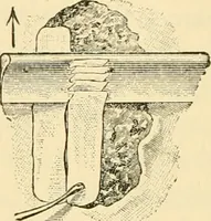 An illustration from Surgical technic; a text-book on operative surgery / by Fr. von Esmarch ... and E. Kowalzig ... translated by Professor Ludwig H. Grau ... and Willam N. Sullivan ... edited by Nicholas Senn ... With fourteen hundred and ninety-seven illustrations and fifteen colored plates. (1901)