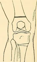 An illustration from Surgical technic; a text-book on operative surgery / by Fr. von Esmarch ... and E. Kowalzig ... translated by Professor Ludwig H. Grau ... and Willam N. Sullivan ... edited by Nicholas Senn ... With fourteen hundred and ninety-seven illustrations and fifteen colored plates. (1901)
