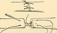 An illustration from Surgical technic; a text-book on operative surgery / by Fr. von Esmarch ... and E. Kowalzig ... translated by Professor Ludwig H. Grau ... and Willam N. Sullivan ... edited by Nicholas Senn ... With fourteen hundred and ninety-seven illustrations and fifteen colored plates. (1901)