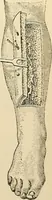 An illustration from Surgical technic; a text-book on operative surgery / by Fr. von Esmarch ... and E. Kowalzig ... translated by Professor Ludwig H. Grau ... and Willam N. Sullivan ... edited by Nicholas Senn ... With fourteen hundred and ninety-seven illustrations and fifteen colored plates. (1901)