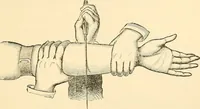 An illustration from Surgical technic; a text-book on operative surgery / by Fr. von Esmarch ... and E. Kowalzig ... translated by Professor Ludwig H. Grau ... and Willam N. Sullivan ... edited by Nicholas Senn ... With fourteen hundred and ninety-seven illustrations and fifteen colored plates. (1901)